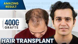 Grade 5 Hair Transplant in Surat | Stunning Hair Transplant Results and Cost #hairtransplant