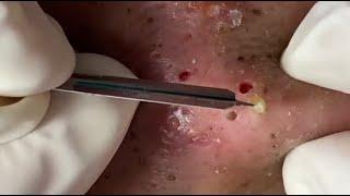 The Most Satisfying Blackhead Removal Technique Part II...Don't Miss Watching It