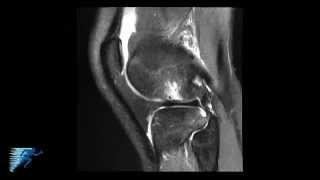 How to Read Knee MRI of ACL Tear | Anterior Cruciate Ligament Pain | Knee Surgery | Minneapolis, MN