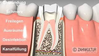 Wie läuft eine Wurzelkanalbehandlung ab? - Wurzelbehandlung beim Zahnarzt -
