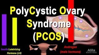 Polycystic Ovary Syndrome (PCOS) Pathology and Treatment, Animation