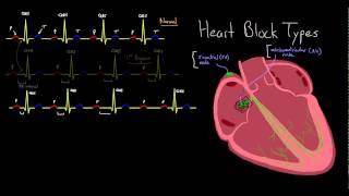 Major Types of Heart Block