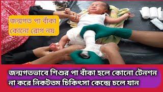 জন্মগত পা বাকা হলে কি করনীয় |Clubfoot baby||SM Jahid Hasan||