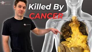 Why Cancer is So Hard to Kill