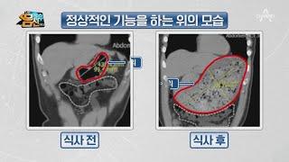 '기능성 소화 불량' 위가 제대로 움직이지 않으면 나타나는 증상 | 나는 몸신이다 354 회