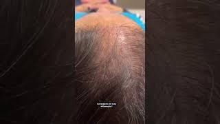 Queda de cabelo: alopecia cicatricial