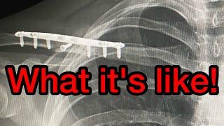What it's like after Collarbone Surgery! X-Rays, How it happened, What surgery was like!