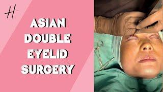 Asian Blepharoplasty Procedure| Before & After| Handa Aesthetics & Plastics