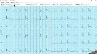 ECG PC EOLYS - mode de fonctionnement