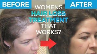 Hair Loss Treatment for Women with Advanced Trichology