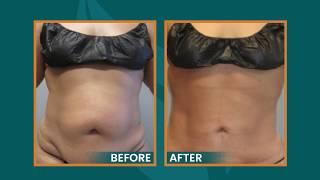 Sono Bello | Laser Liposuction | Tummy E/X | Mini Tummy Tuck