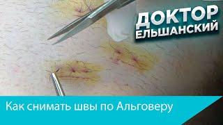 Как снимать швы по Альговеру