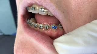 Orthodontic ligation: Figure of 8 tie