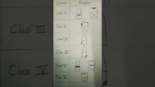 G V Black's classification of dental caries #youtubeshorts #dentist #concise dental studies