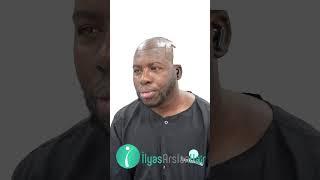 Afro Hair Beard Transplant in Turkey with Ilyas Arslan Hair Clinic