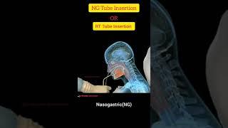 NG ( Nasogastric ) Tube Insertion Techniquen In Hindi  ll RT Tube Insertion Procedure ll SG Pharma