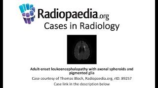 Adult-onset leukoencephalopathy (Radiopaedia.org) Cases in Radiology