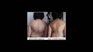 11 Sessions of the better than surgery ASMI for Scoliosis