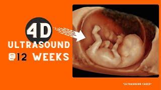 A 4D ultrasound at 12 weeks wiggling !!!.