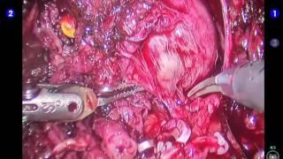 Right pedicle, sparing of neuro-vascular bundle