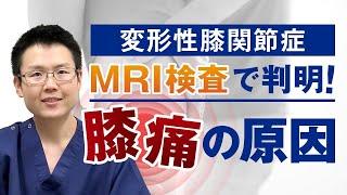 【変形性膝関節症】MRI検査によって明らかになった膝痛の原因！