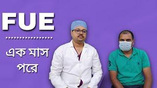 FUE Hair Transplant অপারেশনের একমাস পর | Best Hair Transplant Clinic Kolkata | FUE Result Kolkata