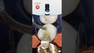 Ultradent Product's Restorative Solution | Case 1