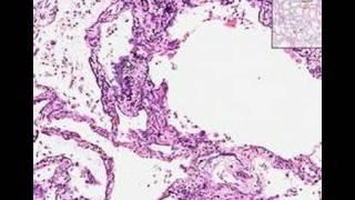 Histopathology Lung, kidney --Metastatic calcification