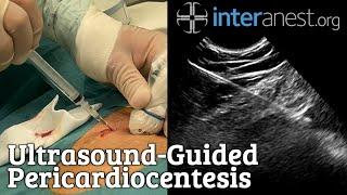 Ultrasound-Guided Pericardiocentesis
