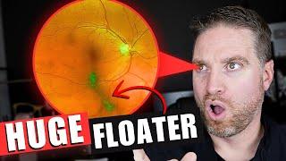 What Causes This Huge Eye Floater!? PVD Treatments Explained