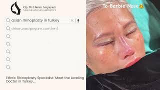 Asian Rhinoplasty with Rib Cartilage | Before - After | Dr.Harun Acıpayam