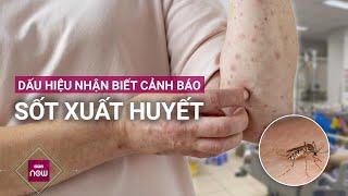 Sốt xuất huyết tưởng là bệnh thường nhưng nếu chủ quan sẽ nguy hiểm đến tính mạng | VTC Now