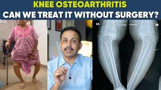 Knee arthritis-Is Surgery the Only Option?