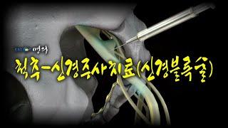 [명의 의학백과] 척추-신경주사치료(신경블록술)