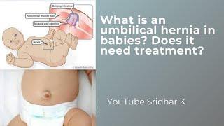 Umbilical hernia in babies-what is it? Does it need any treatment? #umbilicalhernia #umbilicalcord