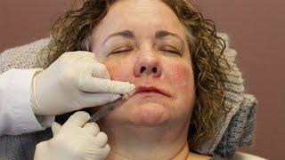 Lip Filler on Thin, Older Lips | 1 Syringe of Juvederm and Volbella