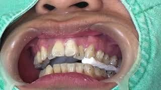 Efficient Aligner Attachment Bonding｜【Chris Chang Ortho】CC567