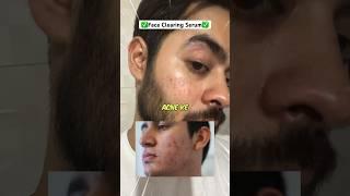 Pimple ke daag hataane ka best tareeka | Best face serum for acne marks , dark spots, pimple marks