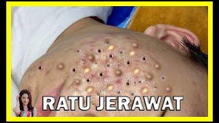 keseruan dari mencetin jerawat PENCET JERAWAT ASMR