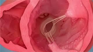 Ancora heart video cut for Chem 1A c