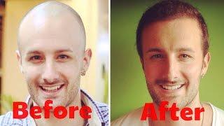 How Much Does A Hair Transplant Cost? - ANSWERED