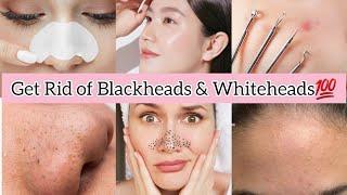Get rid of  BLACKHEADS WHITEHEADS COMEDONES at home | AFFORDABLE skincare routine for Tiny Bumps
