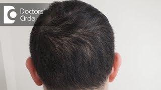 Follicular Unit Transplant vs Follicular Unit Extraction for hair Transplant - Dr. Sahebgowda Shetty