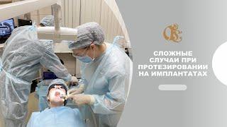 Сложные случаи при протезировании на имплантатах . Гильдия стоматологов- стоматология в Петербурге