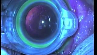 Femtosecond laser cataract surgery with enhanced patient interface kit