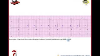 Ekg Podcast 24/56. Bifascikulárne, trifascikulárne bloky. Part 2