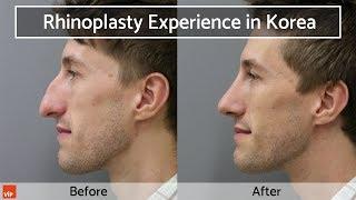 Rhinoplasty at VIP Plastic Surgery Korea (Caucasian / Western Male)