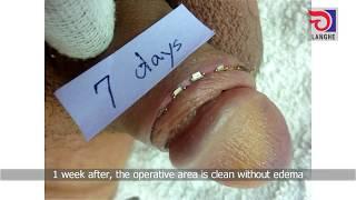 LangHe Medical — Disposable Circumcision Suture Operation Video - Adult