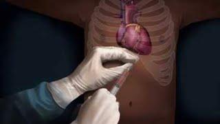 PERICARDIAL EFFUSION || Pericardiocentesis || Increased pericardial fluid || by Dr Raj Mishra #best