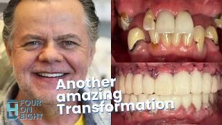 3 on 6™ Implants - Another Amazing Transformation